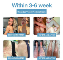 Bee Venom &Ocean Psoriasis Healing Cream ( Pack Of 1 ) image 4